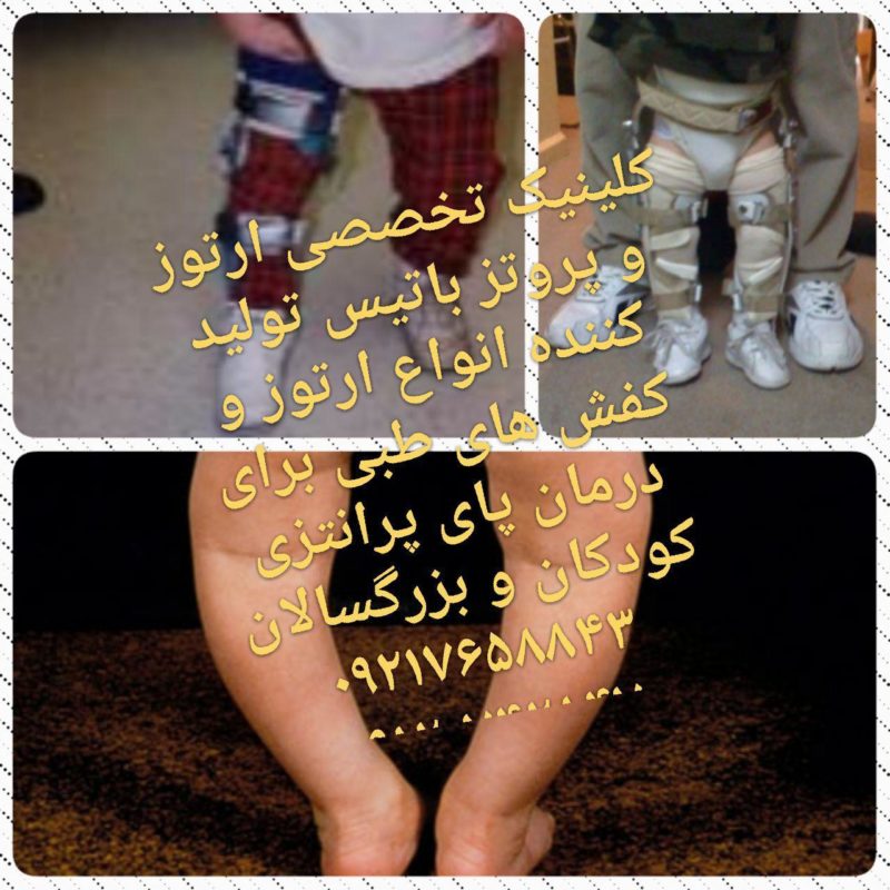 درمان پای پرانتزی در کودکان و بزرگسالان