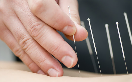 طب سوزنی در مشهد درمانگاه تخصصی طب سنتی