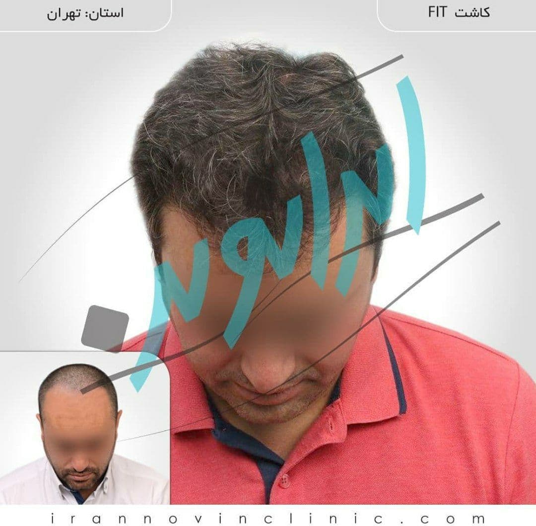 کاشت مو طبیعی با اقساط بلند مدت