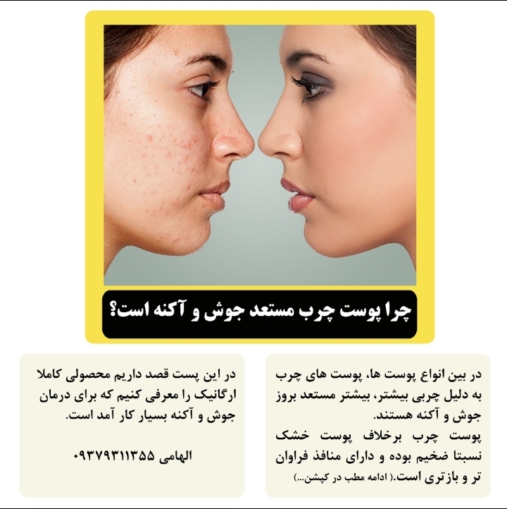درمان خانگی جوش و آکنه با اسکراب مدیترانه ای پیپا(صد در صد ارگانیک)