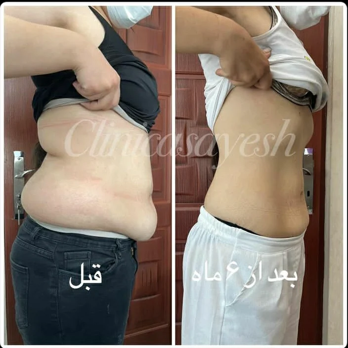 لاغری بدون جراحی با کرایولیپولیز