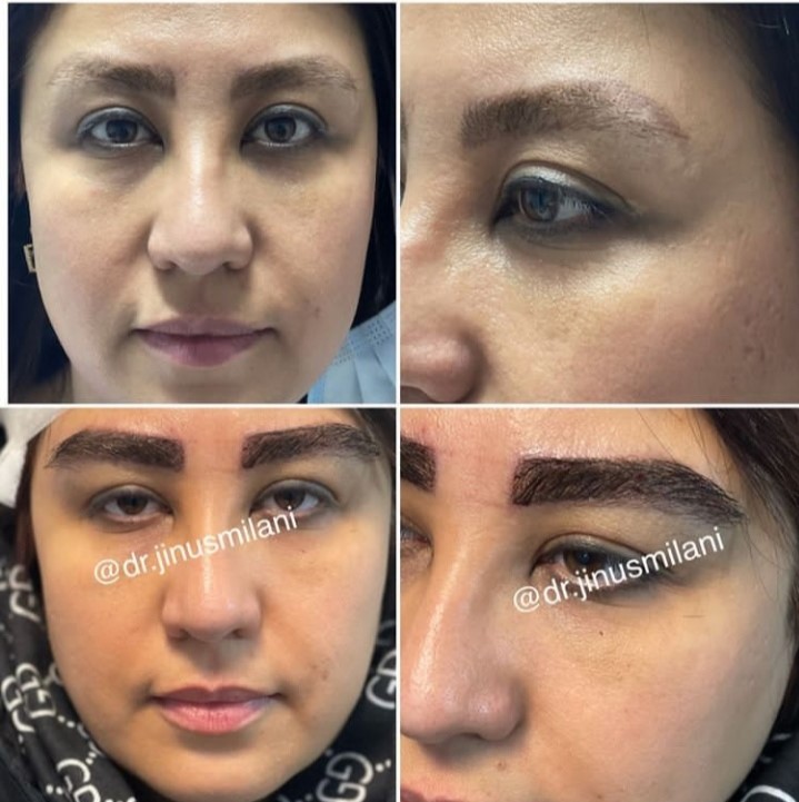 کاشت ابرو کاملا طبیعی و ۱۰۰% تضمینی و پرتراکم