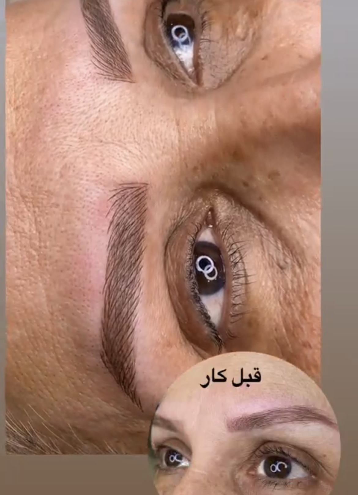 میکروپیگمنتیشن