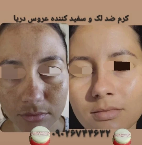 ضد لک و سفید کننده عروس دریا