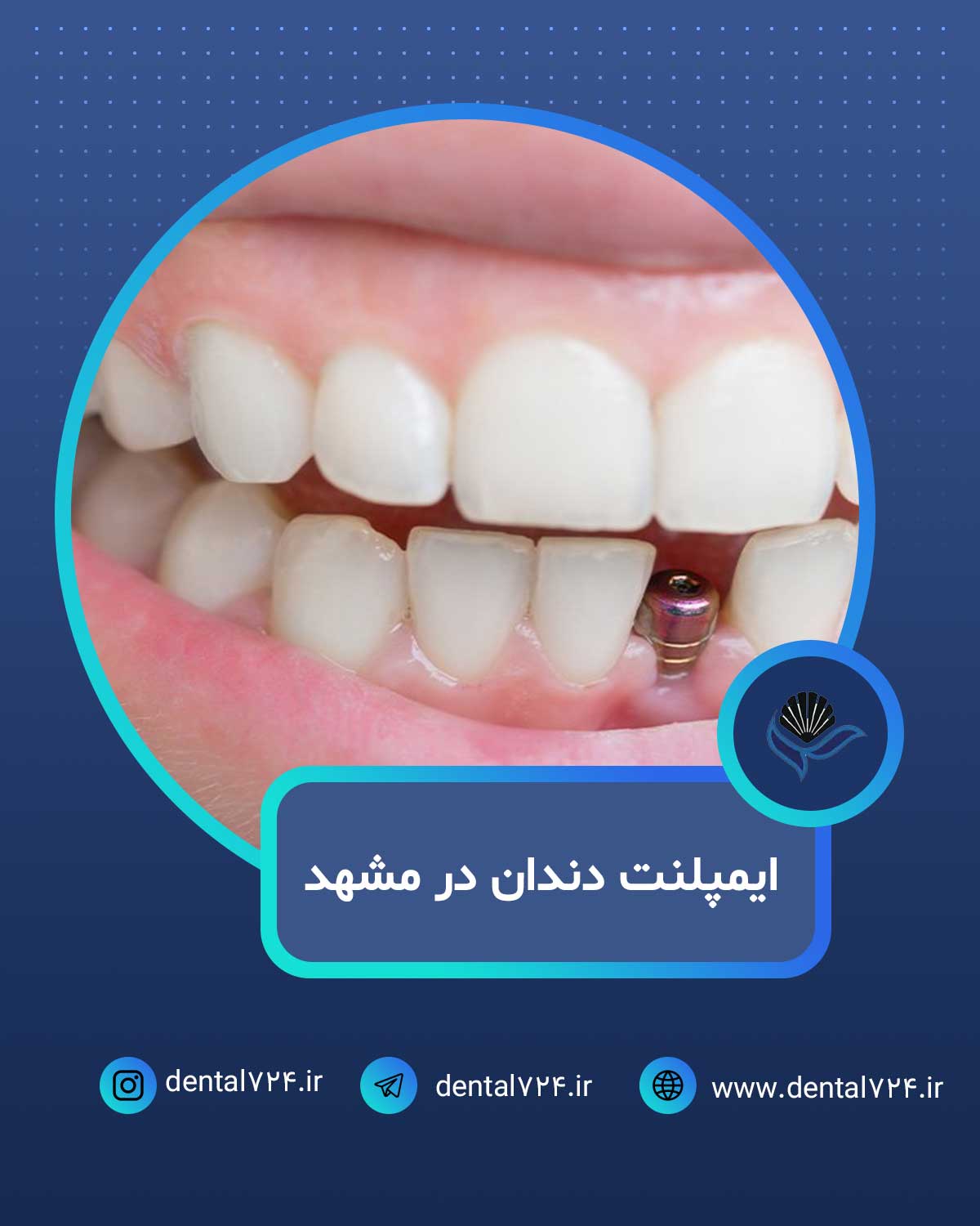 ایمپلنت دندان در مشهد  با اقساط بلندمدت و شرایط ویژه